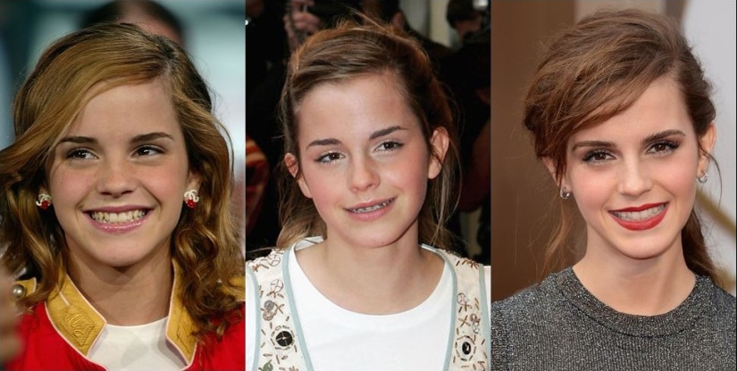 These celebrities will show you how braces can dramatically change your smile.