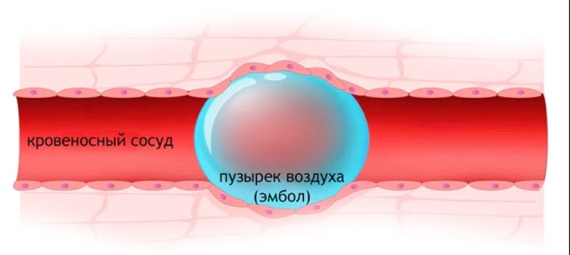 What happens if air gets into a vein?